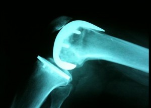 La artrosis de rodilla puede evolucionar hacia una prótesis