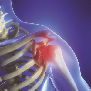 La mayor parte de pacientes con artrosis de hombro no son tratados