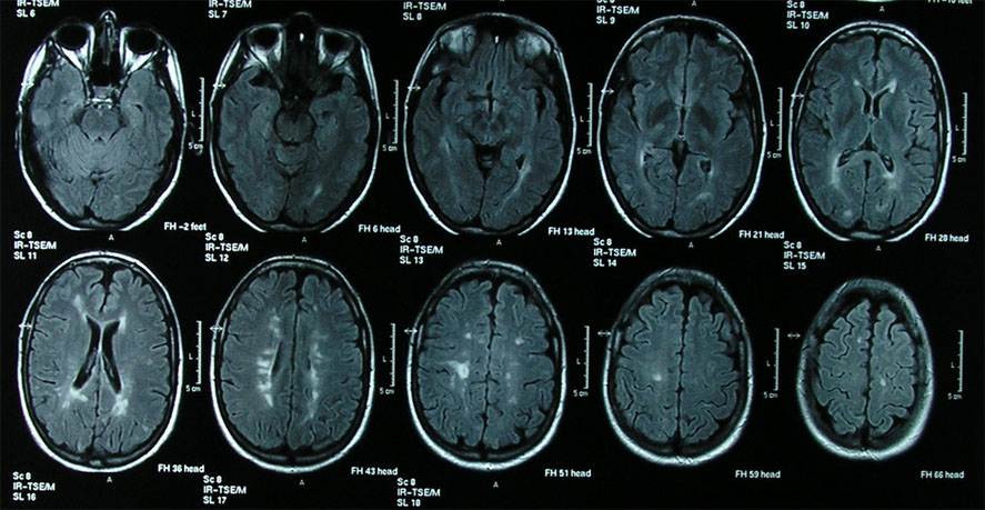 Neurólogos debaten sobre los cambios en el tratamiento de la esclerosis múltiple
