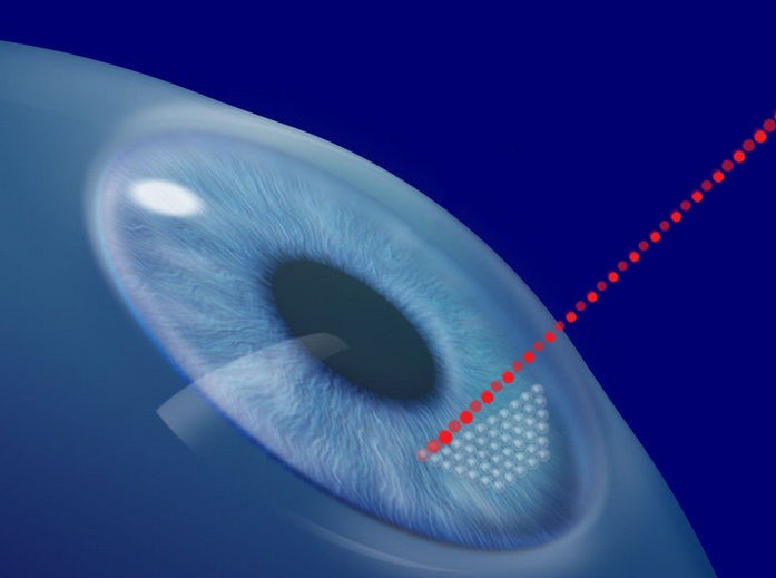 Los oftalmólogos eligen Intralase como mejor láser para operar de miopía