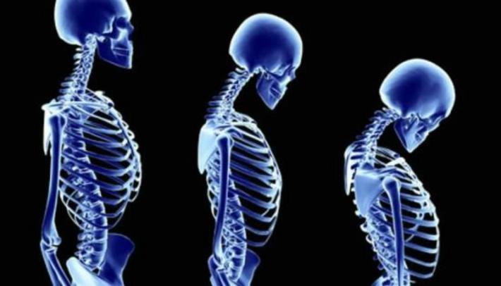 Coronavirus: Consejos para pacientes con osteoporosis