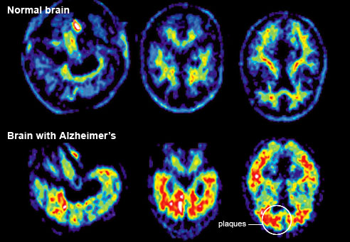 Descubren un tratamiento que podría acabar con el Alzheimer