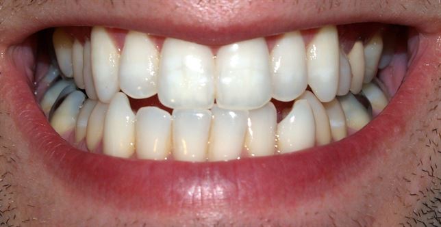Una dieta poco equilibrada afecta al color de los dientes, incrementando su tono amarillento