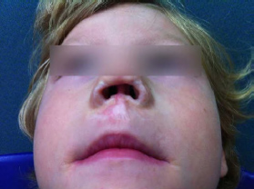 Médicos españoles reconstruyen la nariz de una niña a partir del cartílago y piel de su propia oreja
