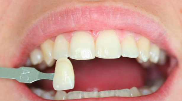 Las carillas dentales, solución indolora para rejuvenecer toda una sonrisa