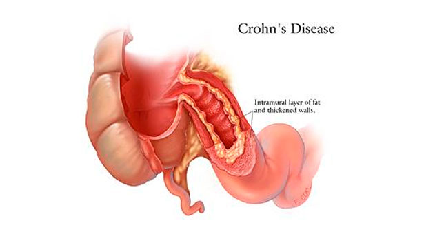 Resultados positivos de un fármaco de Celgene para enfermedad de Crohn