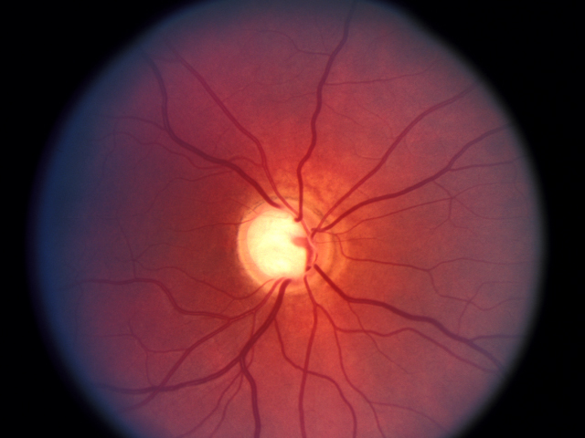 Día Mundial del Glaucoma: qué, cómo, dónde, cuándo y por qué