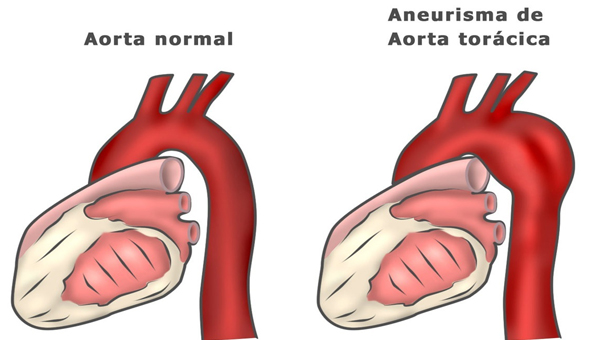 Aneurisma de aorta: accidente en la autopista central