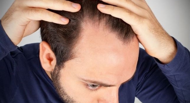 Arrancarse el pelo podría frenar la alopecia