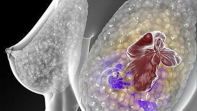 Un análisis de sangre se 'chiva' del riesgo de metástasis en cáncer de mama 3 años antes