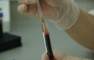 El análisis de sangre periférica diagnostica con mayor precisión el mieloma múltiple
