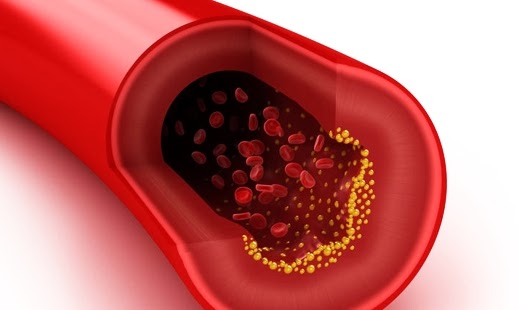 Colesterol que se hereda y que afecta a 1 de cada 5 personas