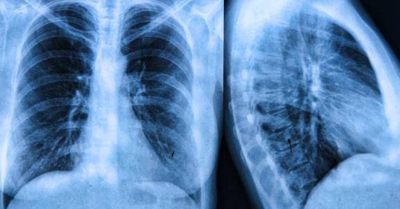 Radiólogos españoles crean una plataforma para el diagnóstico de la fibrosis pulmonar idiopática