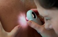 En España se diagnostican 6.179 casos nuevos al año de melanoma cutáneo