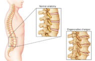 Osteofitos cervicales: espolón óseo en el cuello