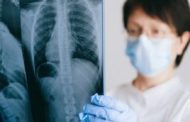 ¿Qué es un nódulo pulmonar? Síntomas, detección y tratamiento