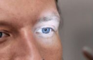 El glaucoma, segunda causa de ceguera evitable