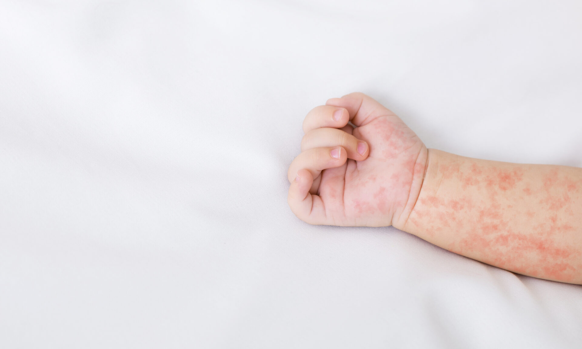 “Boca-mano-pie”: ¿En qué consiste la enfermedad?