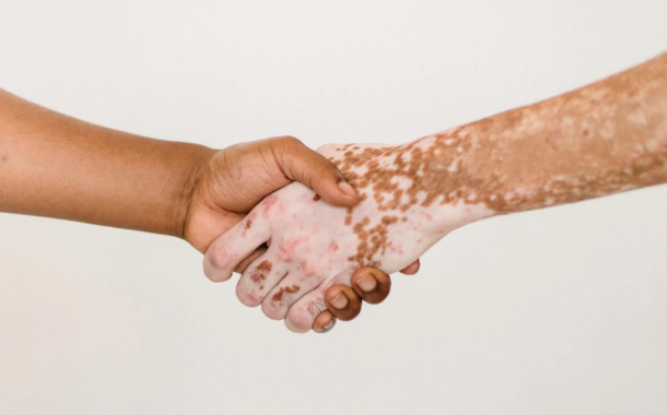 ¿Qué enfermedades de la piel mejoran en verano?