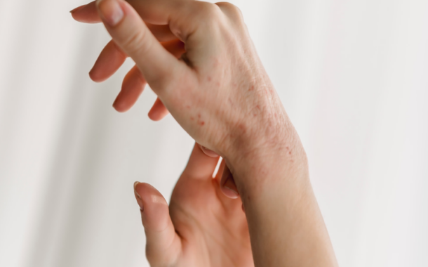 Dishidrosis: ¿Cómo tratarla?