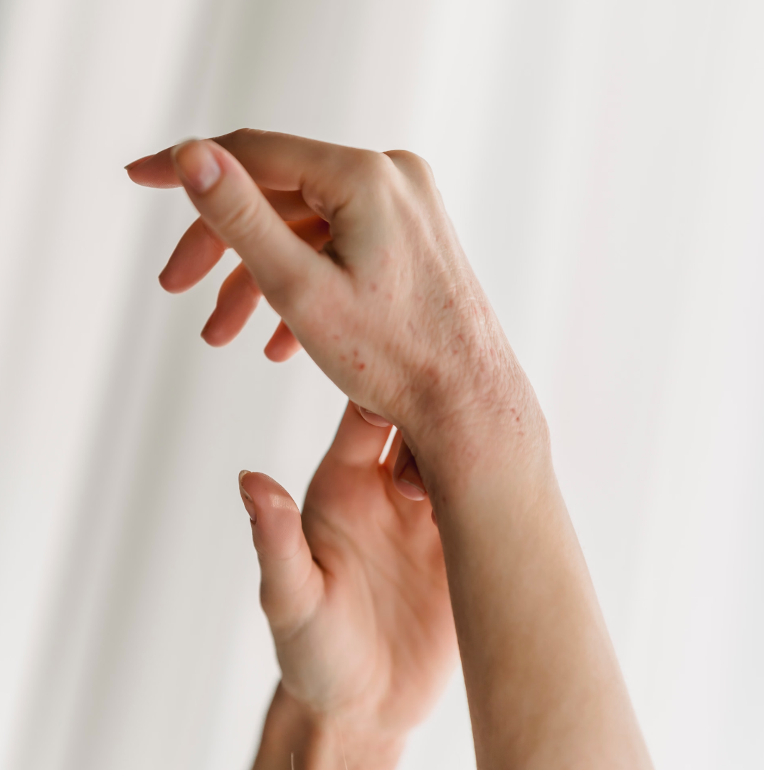 Dishidrosis: ¿Cómo tratarla?